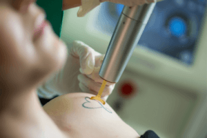 PicoWay® Laser Tattoo Removal